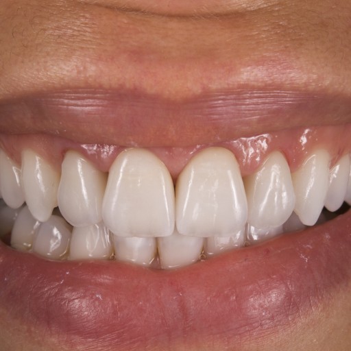 Replacement of 4 front inaccurate ceramic crowns